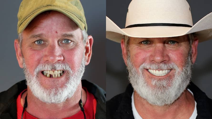 Innovative Implant Smile before and after.