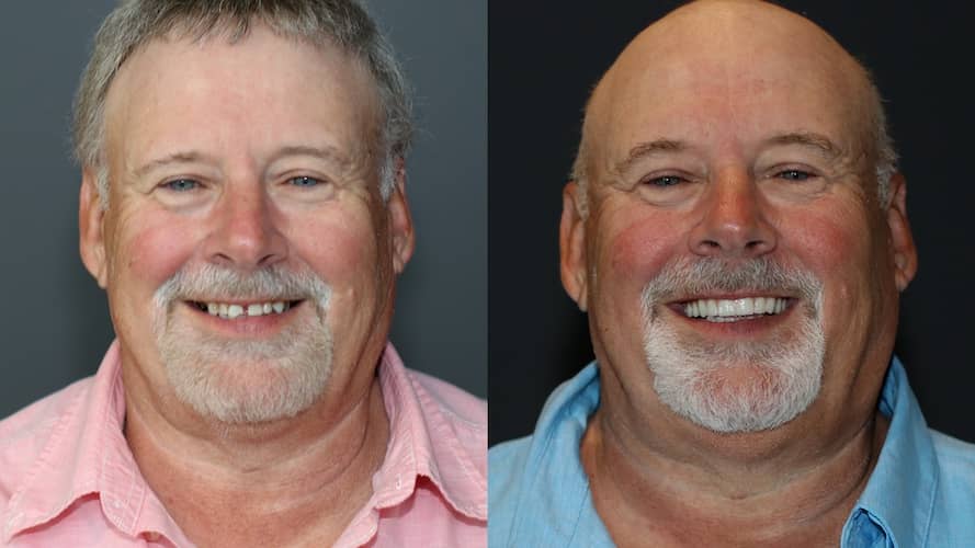 Innovative Implant Smile before and after.