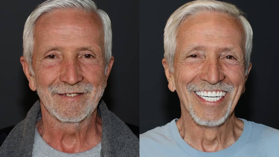 Innovative Implant Smile before and after.