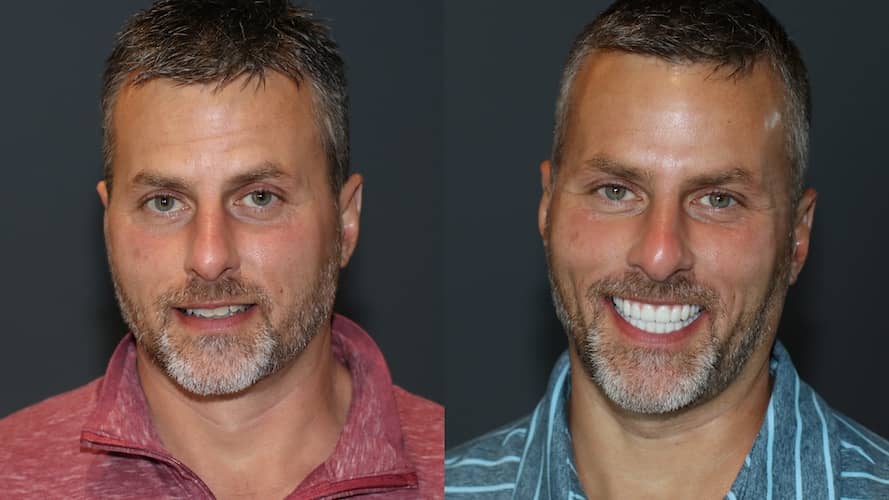 Innovative Implant Smile before and after.