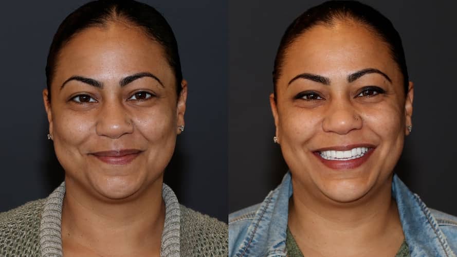 Innovative Implant Smile before and after.