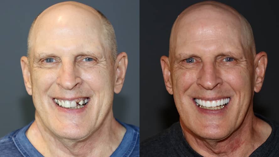 Innovative Implant Smile before and after.