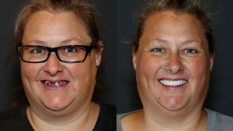 Innovative Implant Smile before and after.