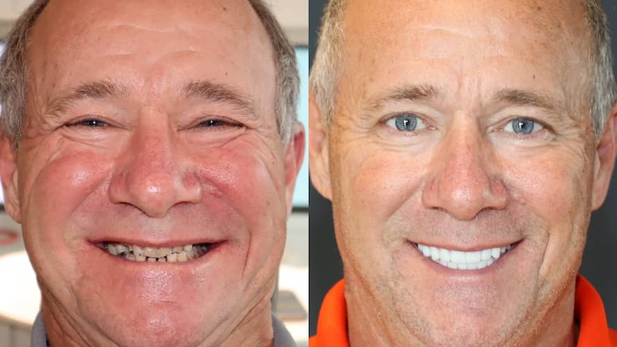 Innovative Implant Smile before and after.