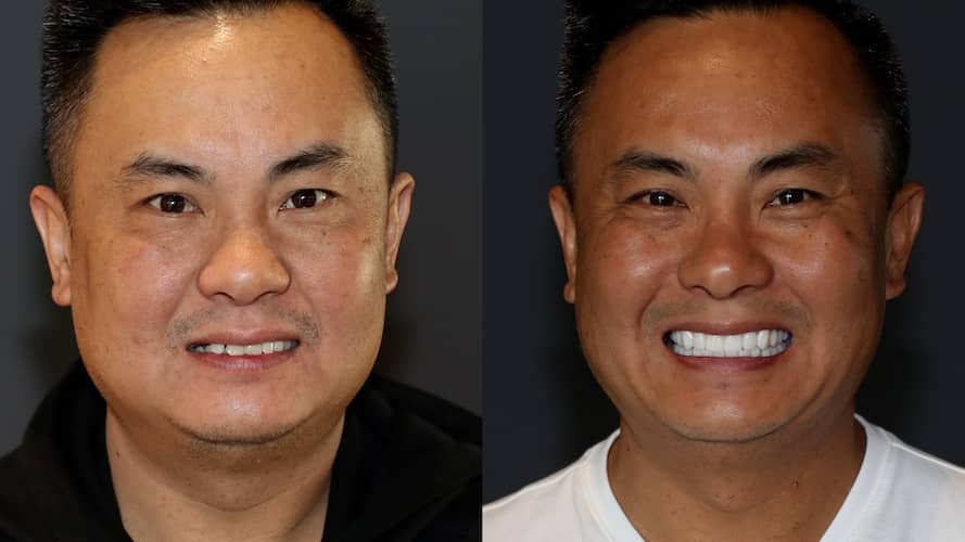 Innovative Implant Smile before and after.